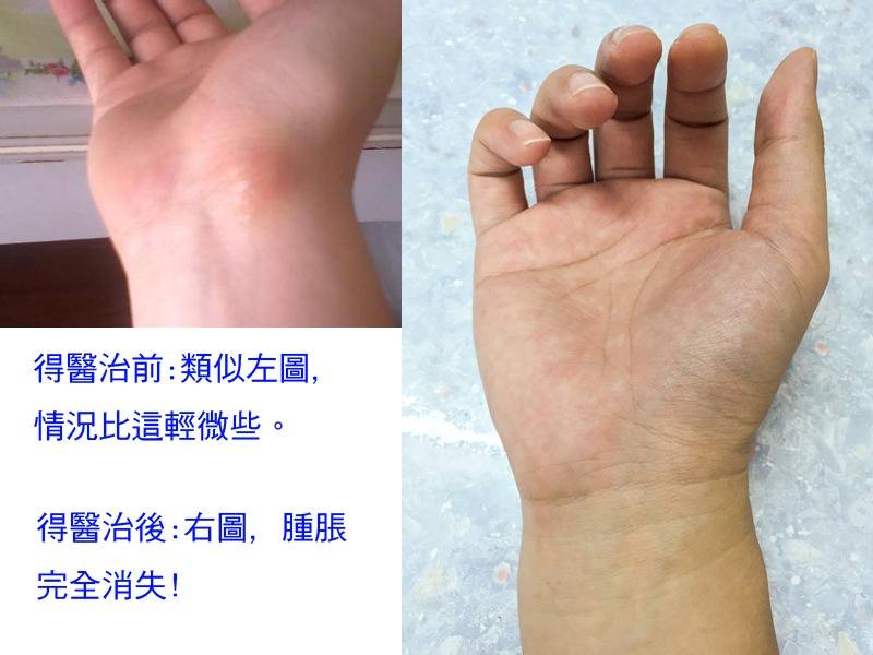 醫治見證 手腕腱鞘炎得醫治